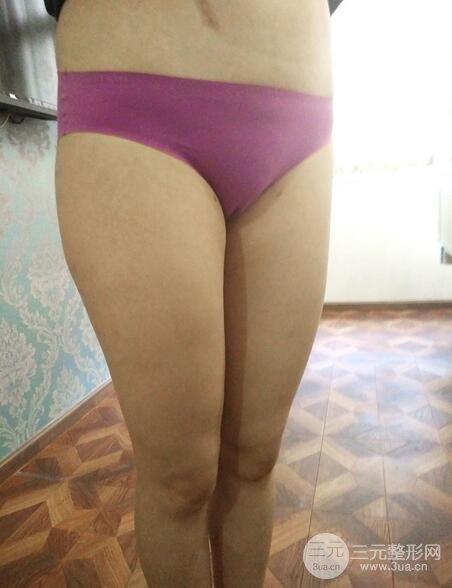 大腿抽脂后的恢復(fù)過程，真人案例真實分享