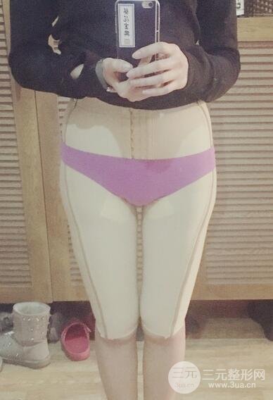 大腿抽脂后的恢復(fù)過程，真人案例真實分享