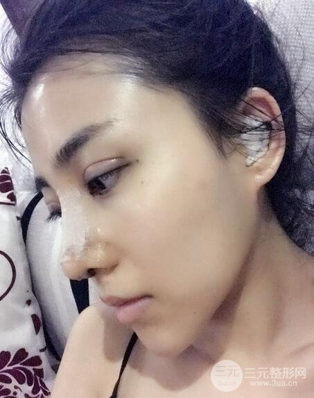 隆鼻整形術(shù)后1-7天的照片，前后對(duì)比果圖分享