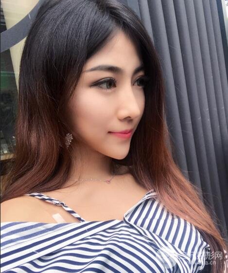 隆鼻整形術(shù)后1-7天的照片，前后對(duì)比果圖分享