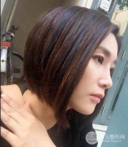 打完鼻子恢復的過程圖，隆鼻案例日記分享