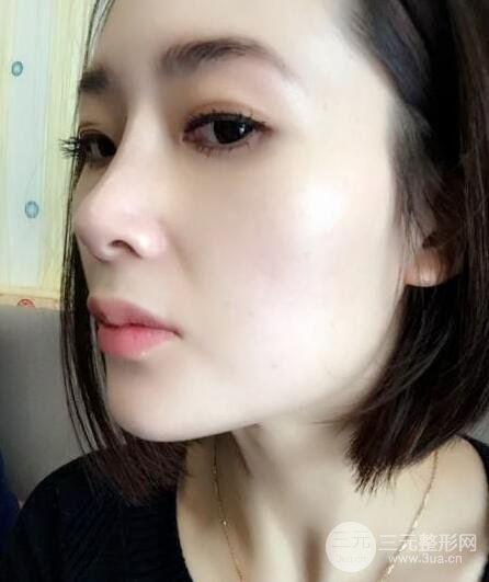 打完鼻子恢復的過程圖，隆鼻案例日記分享