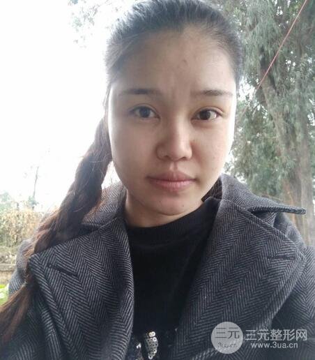 鼻頭縮小術(shù)過(guò)程圖，鼻頭縮小恢復(fù)日記