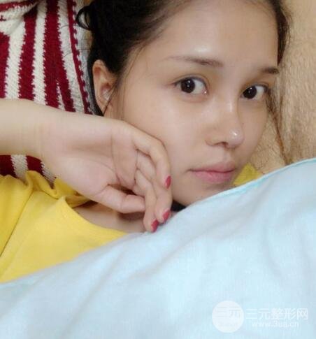 鼻頭縮小術(shù)過(guò)程圖，鼻頭縮小恢復(fù)日記