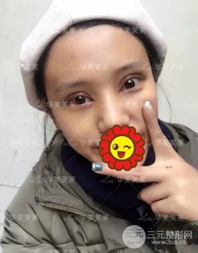 昆明華美楊繼紅全切雙眼皮怎么樣？真實(shí)案例圖片分享~