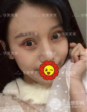 昆明華美楊繼紅全切雙眼皮怎么樣？真實(shí)案例圖片分享~