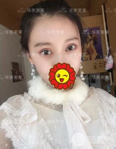 昆明華美楊繼紅全切雙眼皮怎么樣？真實(shí)案例圖片分享~