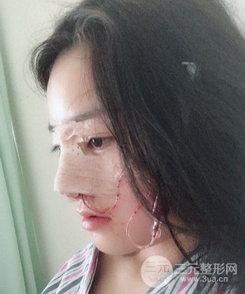 達拉斯綜合隆鼻后對比照片，顏值提高不是夢