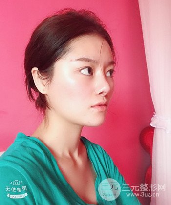 達拉斯綜合隆鼻后對比照片，顏值提高不是夢