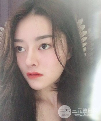 達拉斯綜合隆鼻后對比照片，顏值提高不是夢