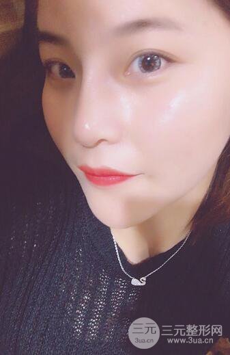 隆鼻鼻翼縮小全過(guò)程和術(shù)后照片分享，隨意揉捏很OK