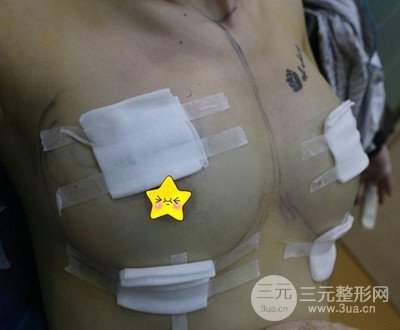 自體脂肪隆胸術后恢復過程分享|成功落實變大胸的愿望