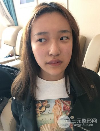 上海面部脂肪填充一個月果超明X、妥妥減齡十歲！