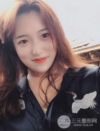 上海面部脂肪填充一個月果超明X、妥妥減齡十歲！