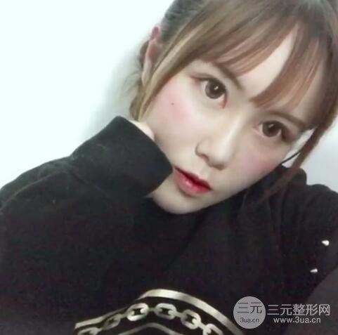 自體脂肪填充全臉基本換臉，改臉型不只是磨骨才能做到！