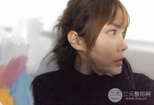 自體脂肪填充全臉基本換臉，改臉型不只是磨骨才能做到！