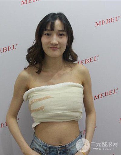 蘇州美貝爾假體隆胸案例，對(duì)比圖恢復(fù)過(guò)程分享~