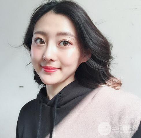 【肋軟骨隆鼻+歪鼻矯正案例】降低風(fēng)險無排異，可隨意揉捏