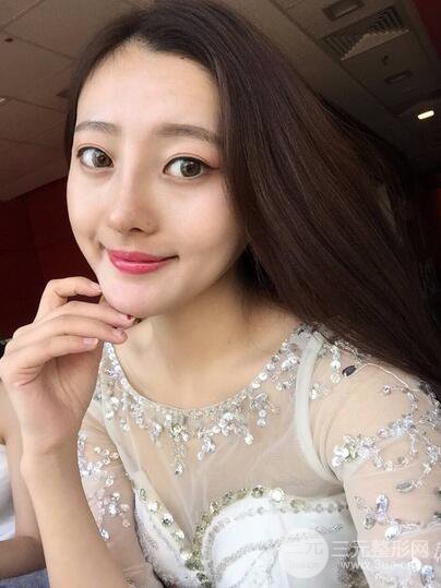 【肋軟骨隆鼻+歪鼻矯正案例】降低風(fēng)險無排異，可隨意揉捏