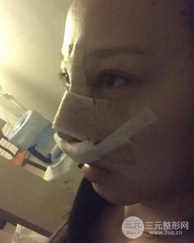 武漢美侖陳遠(yuǎn)海假體隆鼻案例，恢復(fù)過(guò)程分享~