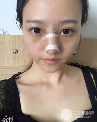 武漢美侖陳遠(yuǎn)海假體隆鼻案例，恢復(fù)過(guò)程分享~