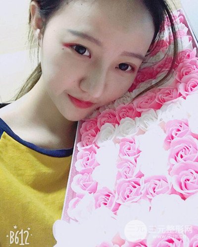 武漢美侖陳遠(yuǎn)海假體隆鼻案例，恢復(fù)過(guò)程分享~