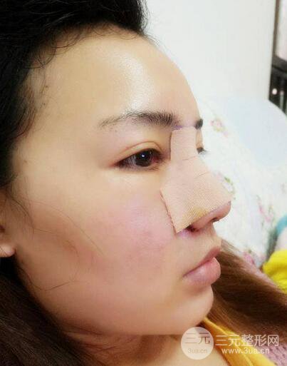 耳軟骨隆鼻全過程及術(shù)后果分享，親身體驗(yàn)~
