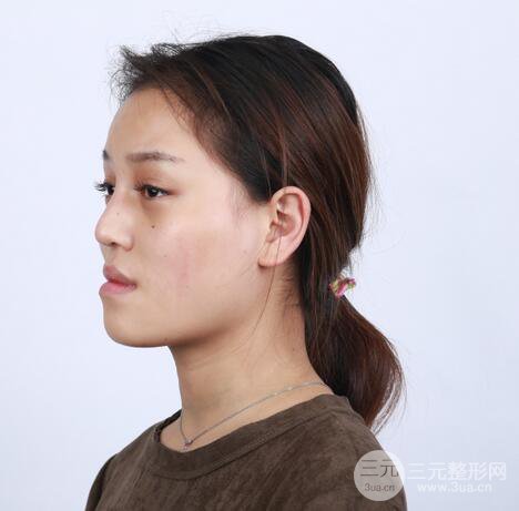 【下頜角+顴骨+下巴】全臉磨骨整形，術(shù)后的我人生開掛了！