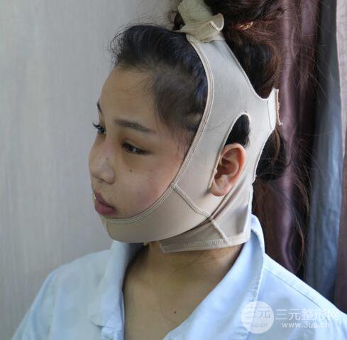 【下頜角+顴骨+下巴】全臉磨骨整形，術(shù)后的我人生開掛了！