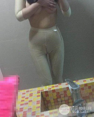 廣州韓妃大腿吸脂案例，恢復(fù)過程前后對比圖片分享~