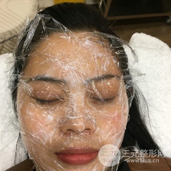 廣州激光祛雀斑果不反彈、恢復(fù)過程圖片分享