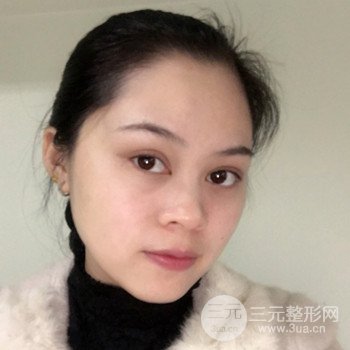 廣州激光祛雀斑果不反彈、恢復(fù)過程圖片分享