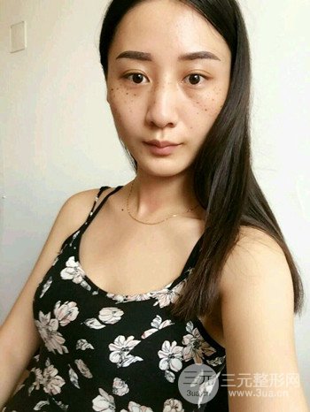 朱彤玥激光祛斑案例、兩個(gè)月果對比超明X
