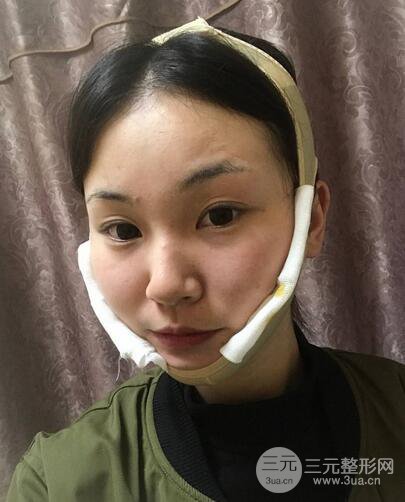下頜角磨骨整形全過程分享，附上術后恢復照片~