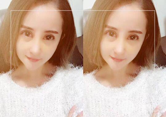 硅膠隆鼻術(shù)前術(shù)后對(duì)比照片分享，走上顏值頂峰