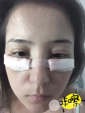 廣州內(nèi)切去眼袋術(shù)后恢復(fù)過程案例對比分享