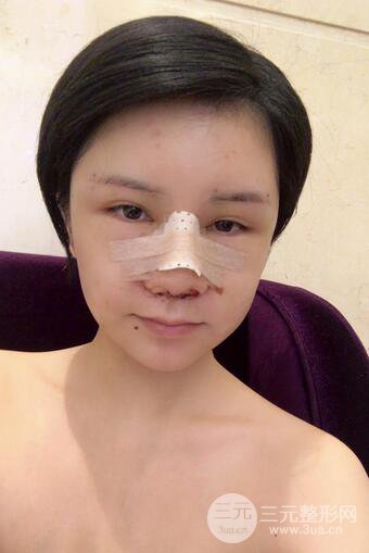 做了隆鼻整形隆鼻之后，短發(fā)女孩也可以性感！