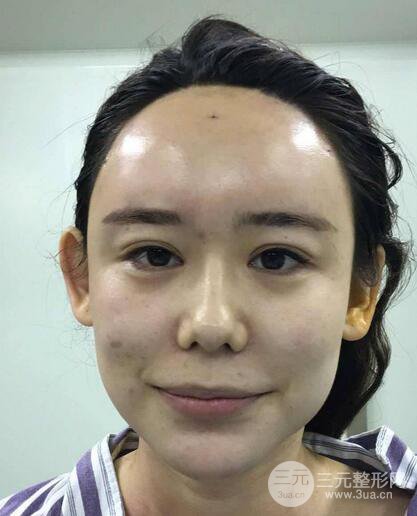 全臉自體脂肪填充，填充不飽滿還可以瘦臉_真人案例