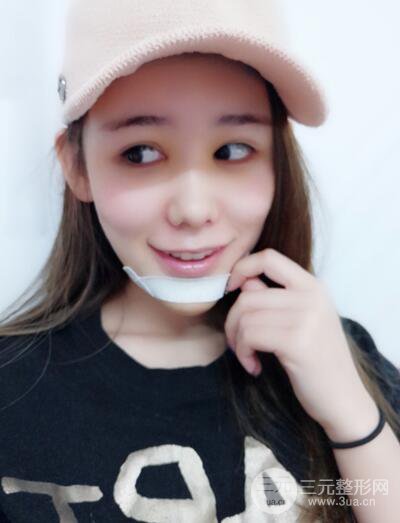 全臉自體脂肪填充，填充不飽滿還可以瘦臉_真人案例