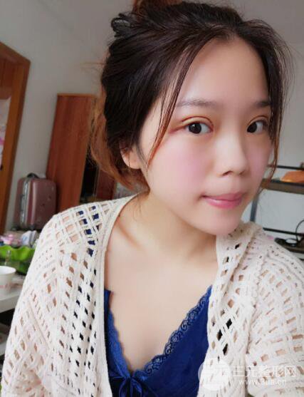 深圳朱武根雙眼皮案例術(shù)后恢復(fù)果記錄