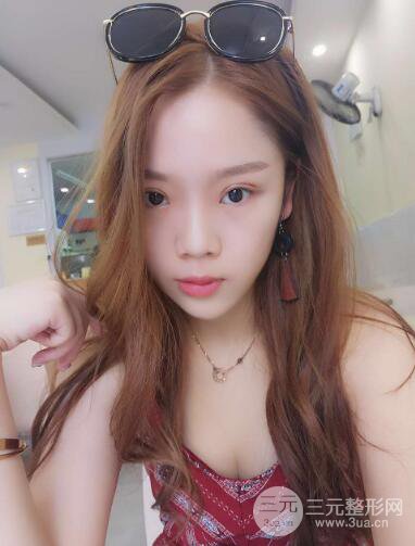 深圳朱武根雙眼皮案例術(shù)后恢復(fù)果記錄