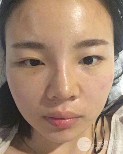 蘇州美萊尹飛隆鼻整形案例，前后恢復(fù)圖分享~