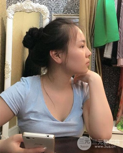 蘇州美萊尹飛隆鼻整形案例，前后恢復(fù)圖分享~