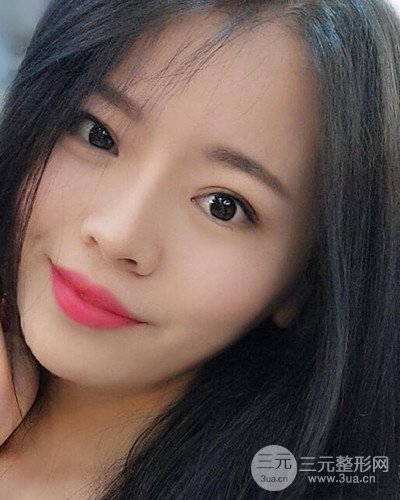 蘇州美萊尹飛隆鼻整形案例，前后恢復(fù)圖分享~