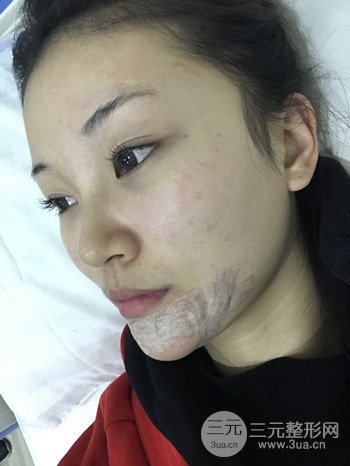 濟(jì)南硅膠假體墊下巴真人案例、下巴改變整個(gè)臉型