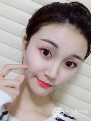 濟(jì)南硅膠假體墊下巴真人案例、下巴改變整個(gè)臉型