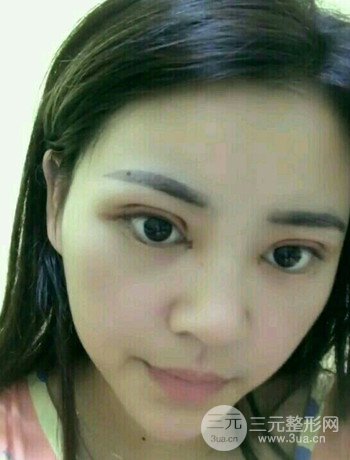 西安切開雙眼皮開眼角手術(shù)案例恢復(fù)過程圖分享