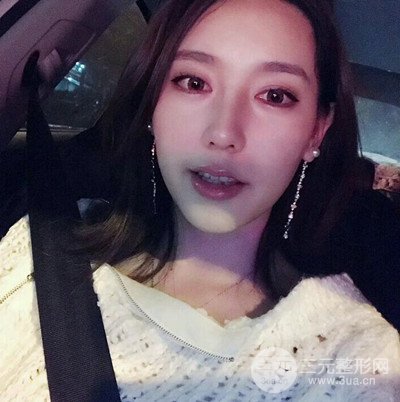 成都華顏黃富偉自體軟骨隆鼻案例前后對(duì)比圖分享