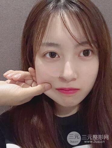 華美許再榮雙眼皮案例恢復(fù)果,閉眼微創(chuàng)~