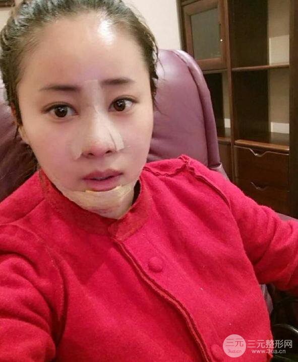 成都華顏賈德淵隆鼻失敗修復(fù)真實案例分享，并且附上前后對比照片